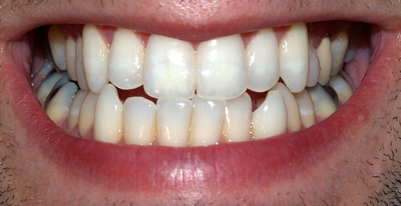 baking soda on teeth enamel