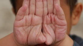 Why Fingers Wrinkle in Water