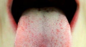 How to Tell if You are a Supertaster