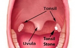 What Those Nasty White Chunks That Sometimes Come From Your Throat Are