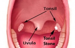 Tonsil-Stones