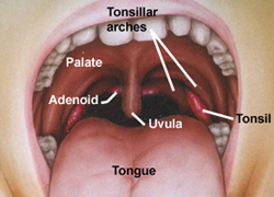Pot tonsil stones