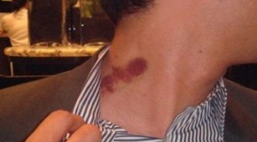 What Causes Hickeys
