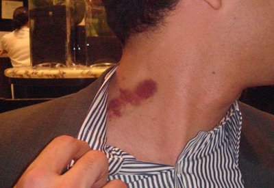 Does a hickey represent