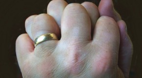 Cracking Your Knuckles Does Not Cause Arthritis