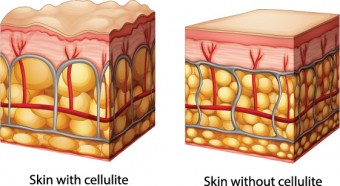 cellulite