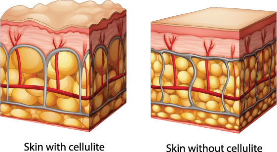 Treat Cellulite Tips