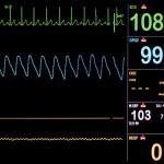 ECG