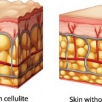 cellulite-340x186