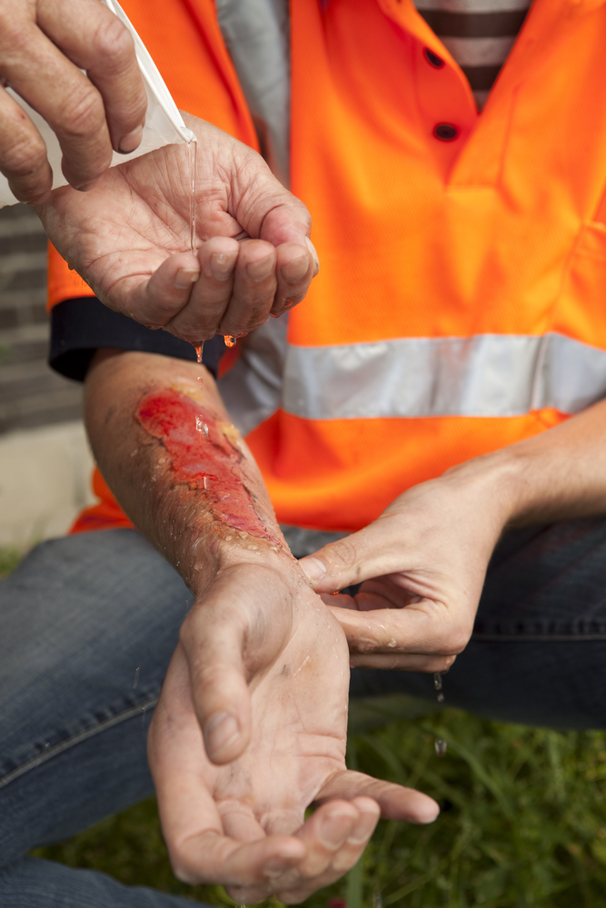 How important is first aid treatment in the healing process for a burn?