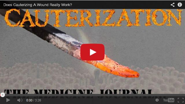 Cauterization - Males Infestus Cauterization - Males Infestus