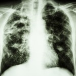 tuberculosis