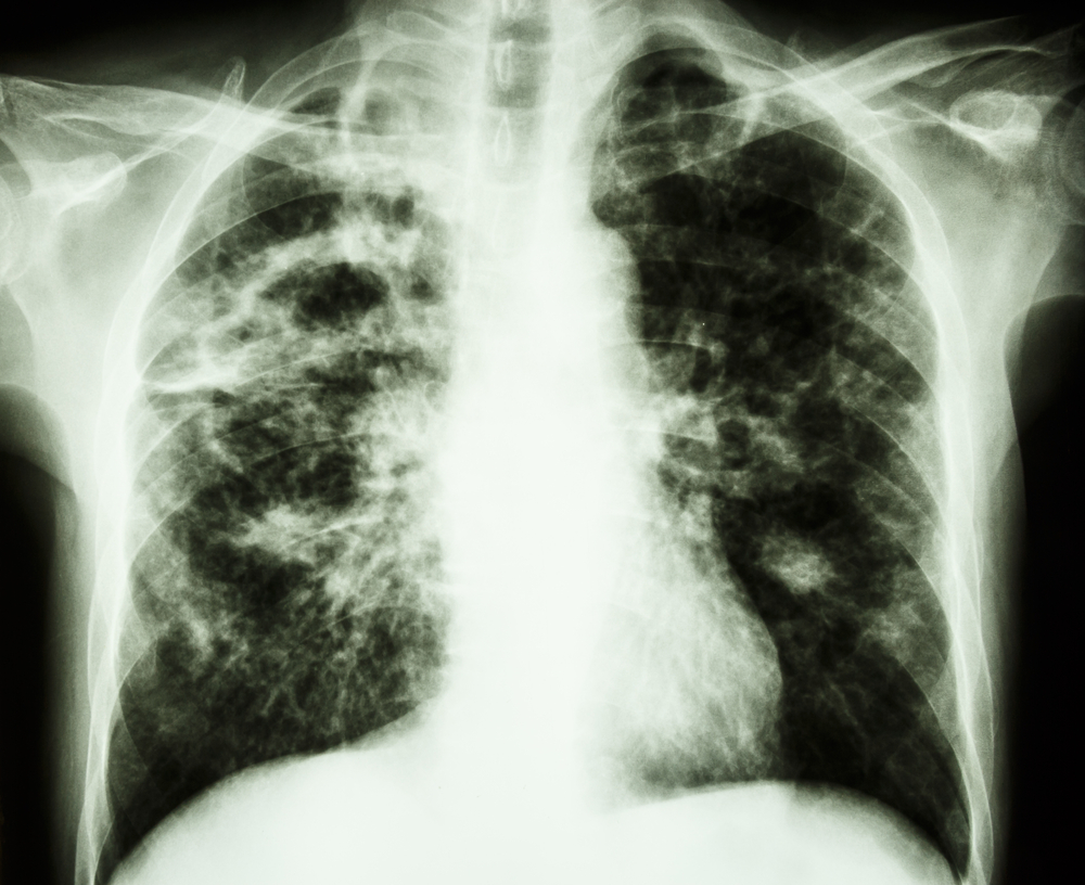 Why Tuberculosis was Called "Consumption"