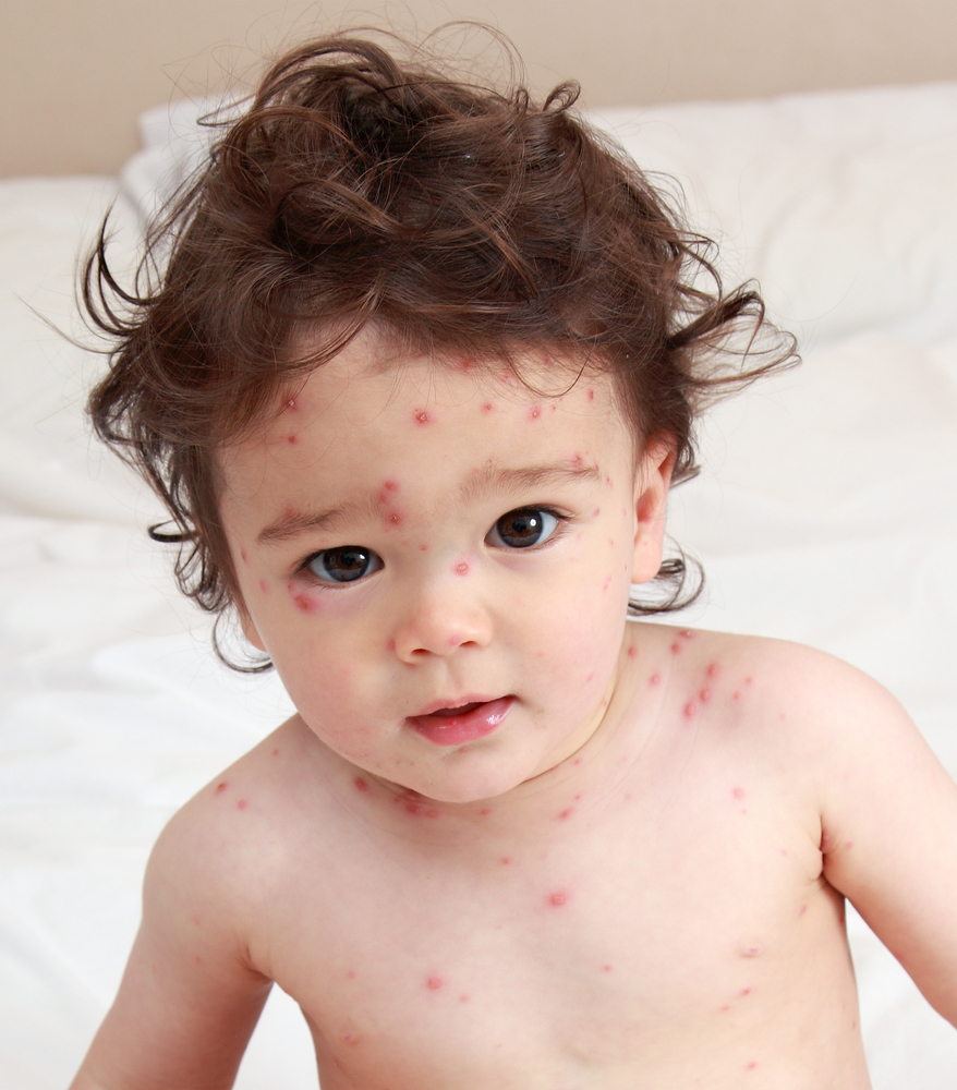 How Chickenpox Got Its Name