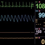 ECG-340x236