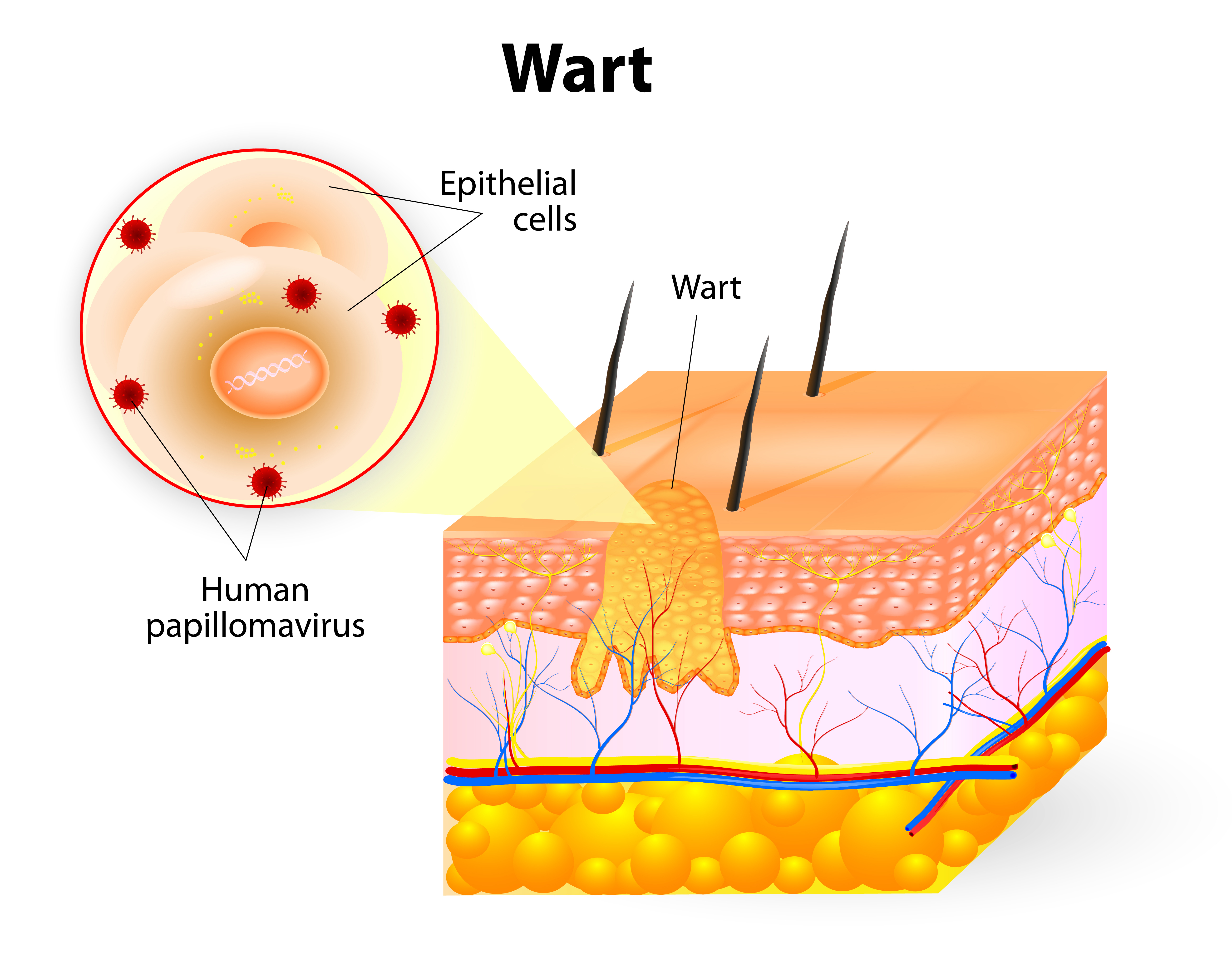 wart virus causes