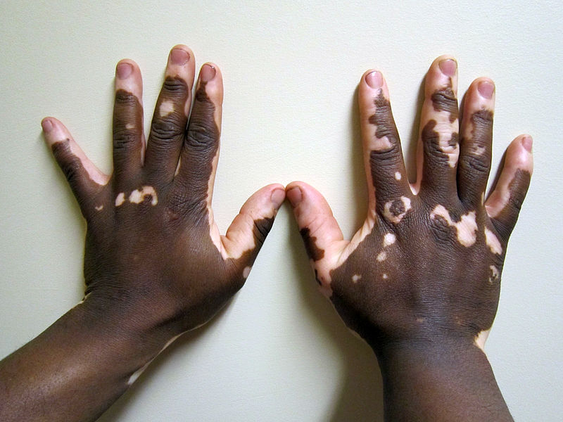 Pictures of Skin Pigment Problems - Addison's Disease