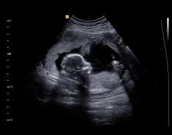 ultrasound-baby