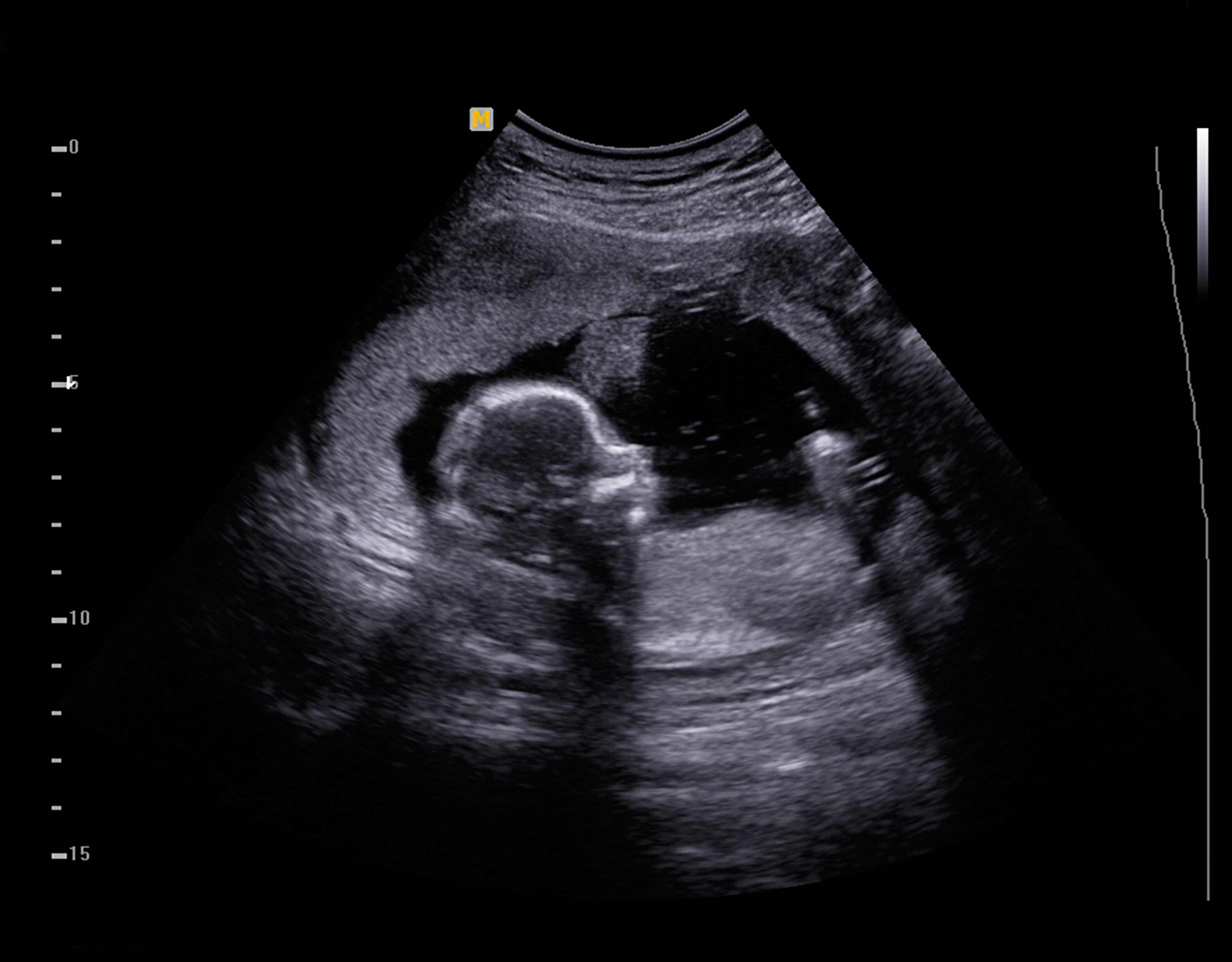 Ultrasounds Sex Of Baby 49