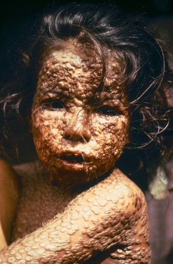 Child_with_Smallpox_Bangladesh