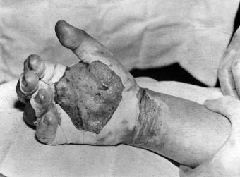 Daghlian's Hand August 21, 1945