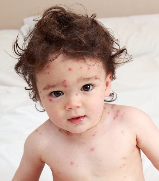How Chickenpox Got Its Name
