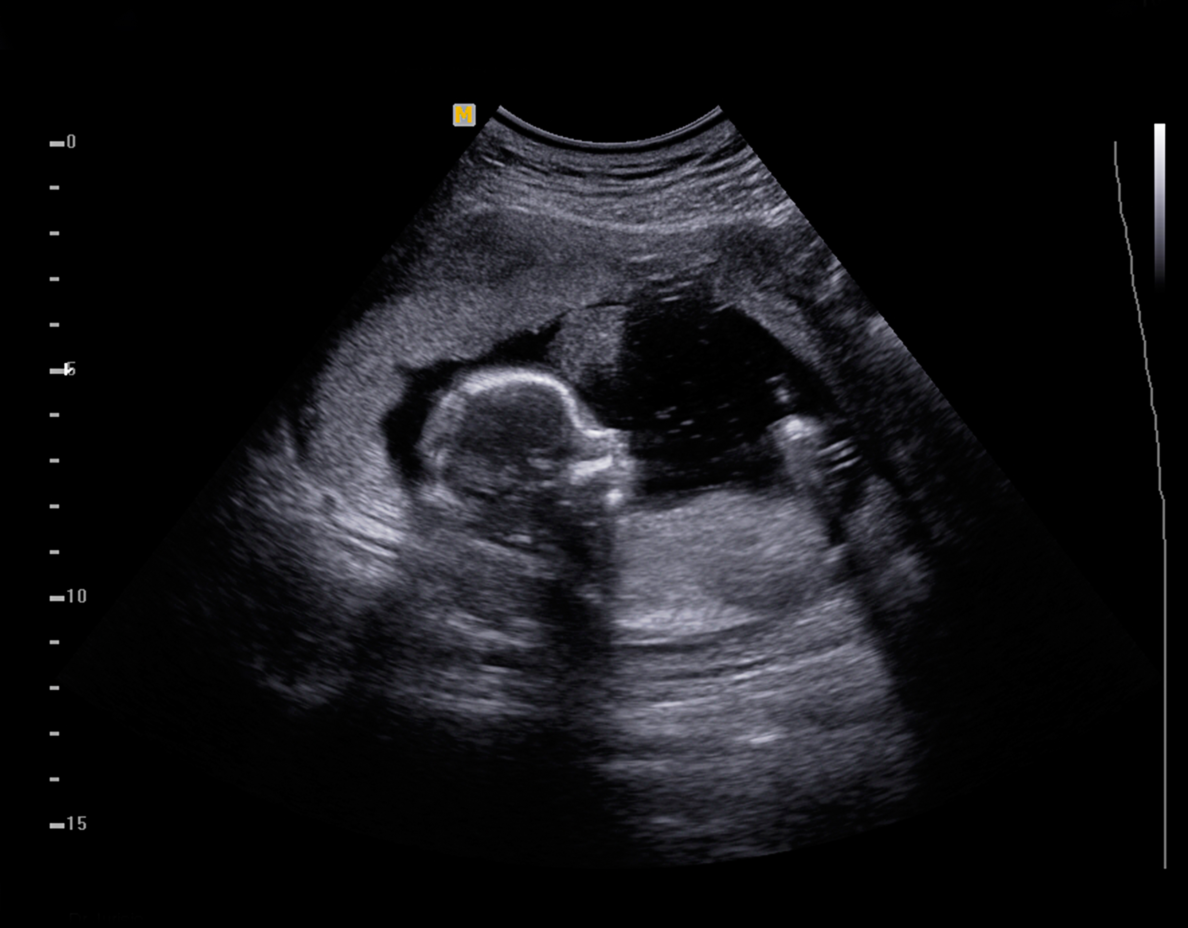 Baby Ultrasound Pictures Twins - Get More Anythink's