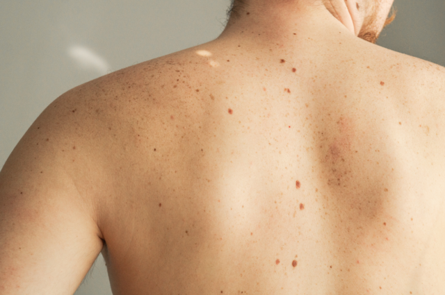 Why Do We Have Moles All Over Our Bodies and What Do They Do?